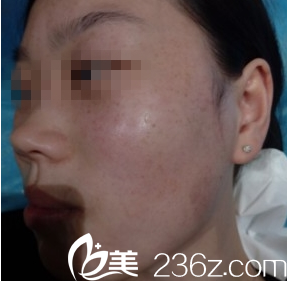 大同美神激光祛斑案例術(shù)前 大同美神激光祛斑案例術(shù)前