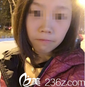 大同美神激光祛斑術(shù)后15天 大同美神激光祛斑術(shù)后15天