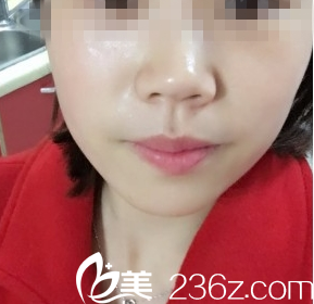 大同美神激光祛斑術(shù)后50天效果 大同美神激光祛斑術(shù)后50天效果