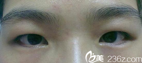 腫泡眼總給人感覺沒睡醒，沒精神