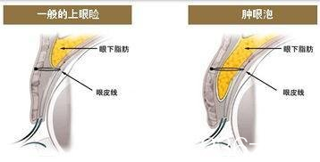 正常的上眼瞼與腫泡眼的上眼瞼對比示意圖