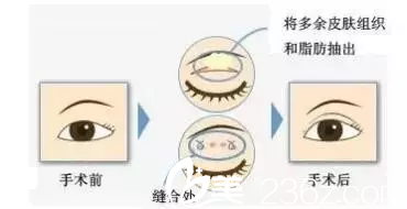 脂肪型的腫泡眼通過切開雙眼皮去除多余的脂肪改善眼型