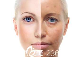 皮膚松弛型腫泡眼用切開雙眼皮法切掉下垂的皮膚改善眼型