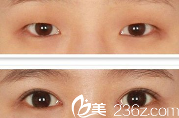 腫泡眼通過割雙眼皮改善眼型的前后對比