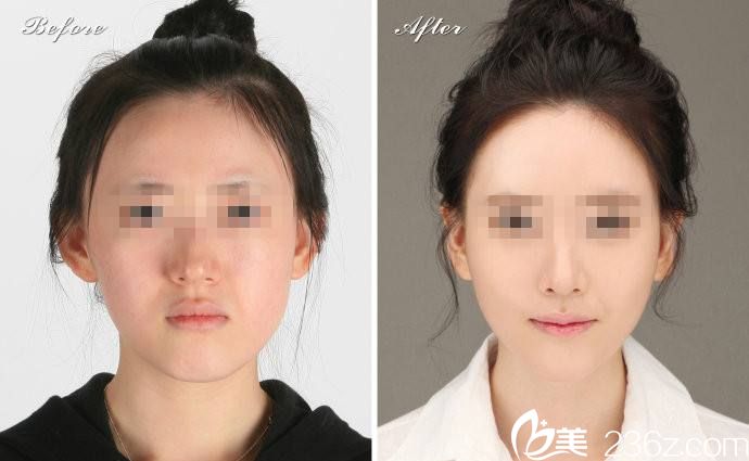 注射玻尿酸前后對(duì)比圖