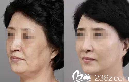 埋蛋白線前后對(duì)比圖