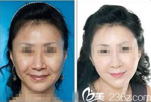 注射瘦臉除皺前后對(duì)比圖