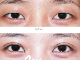 北京煤醫(yī)整形梁偉生切開雙眼皮開眼角案例 北京煤醫(yī)整形梁偉生切開雙眼皮開眼角案例