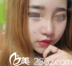 韓國will醫(yī)院魏亨坤鼻綜合手術(shù)后第10天