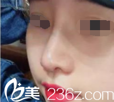 韓國will醫(yī)院鼻綜合手術(shù)后20天