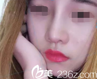 魏亨坤院長鼻綜合術(shù)后兩個(gè)月