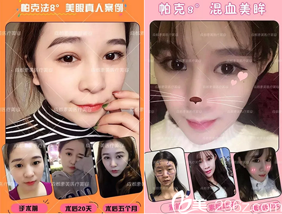 楊迪帕克8度美眼案例 楊迪帕克8度美眼案例