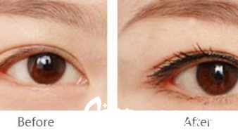 北京煤醫(yī)整形紋繡案例