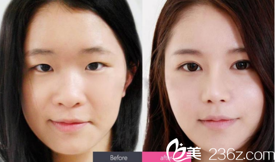 濟(jì)寧韓美醫(yī)院雙眼皮怎么樣？多少錢？?jī)?yōu)惠特價(jià)12222元