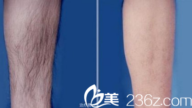 北京煤醫(yī)整形史芳醫(yī)生脫毛案例