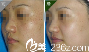 北京煤醫(yī)整形史芳醫(yī)生祛斑案例
