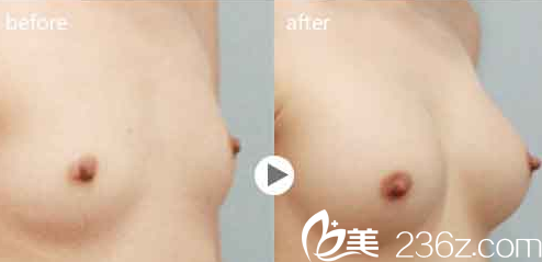 寧夏華美整形何林隆胸真人案例