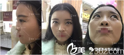 <!--<i data=20240703-sp></i>-->醫(yī)院代忠洪膨體綜合隆鼻術(shù)前照 <!--<i data=20240703-sp></i>-->醫(yī)院代忠洪膨體綜合隆鼻術(shù)前照