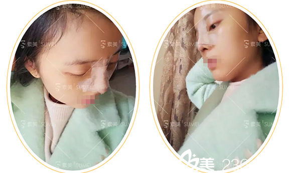 代忠洪膨體綜合隆鼻術(shù)后1天側(cè)面照 代忠洪膨體綜合隆鼻術(shù)后1天側(cè)面照