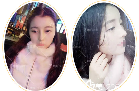 代忠洪膨體綜合隆鼻手術(shù)25天 代忠洪膨體綜合隆鼻手術(shù)25天