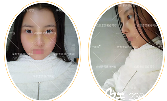 <!--<i data=20240703-sp></i>-->代忠洪鼻綜合拆線后效果 <!--<i data=20240703-sp></i>-->代忠洪鼻綜合拆線后效果