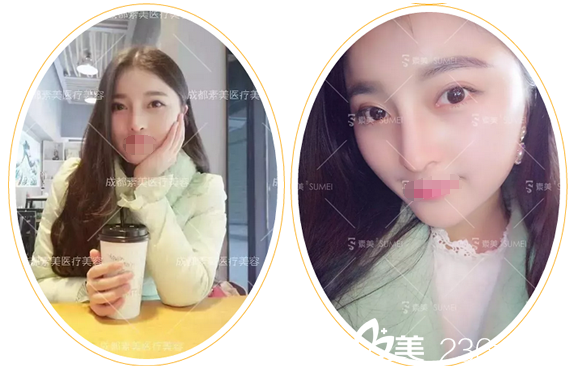 真人案例：?醫(yī)院代忠洪膨體大綜合隆鼻術(shù)后60天恢復(fù)效果