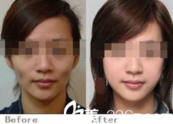 自體脂肪前后對(duì)比圖