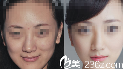 注射玻尿酸前后對(duì)比圖