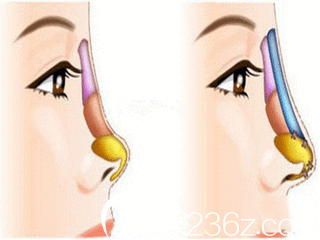 自體軟骨隆鼻前后對(duì)比