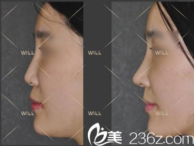 will醫(yī)院自體軟骨鼻綜合真人案例