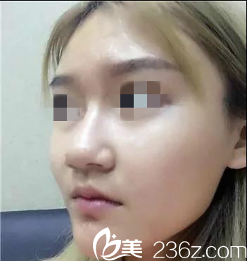 鼻子大怎么辦 鼻子大怎么辦