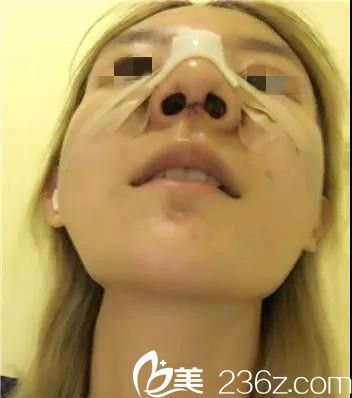 韓國(guó)will醫(yī)院隆鼻手術(shù)天 韓國(guó)will醫(yī)院隆鼻手術(shù)天