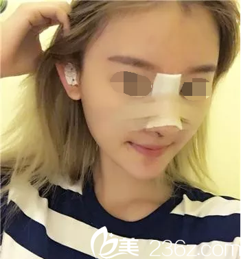 魏亨坤院長(zhǎng)鼻綜合手術(shù)第三天 魏亨坤院長(zhǎng)鼻綜合手術(shù)第三天