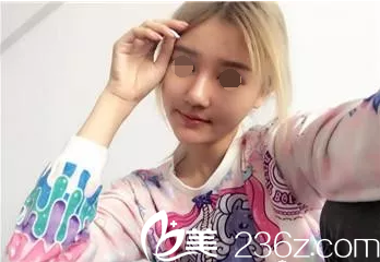 韓國(guó)will手術(shù)第二十天 韓國(guó)will手術(shù)第二十天