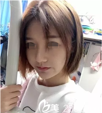 will醫(yī)院好嗎？韓國(guó)魏亨坤丑鼻變美鼻真人案例