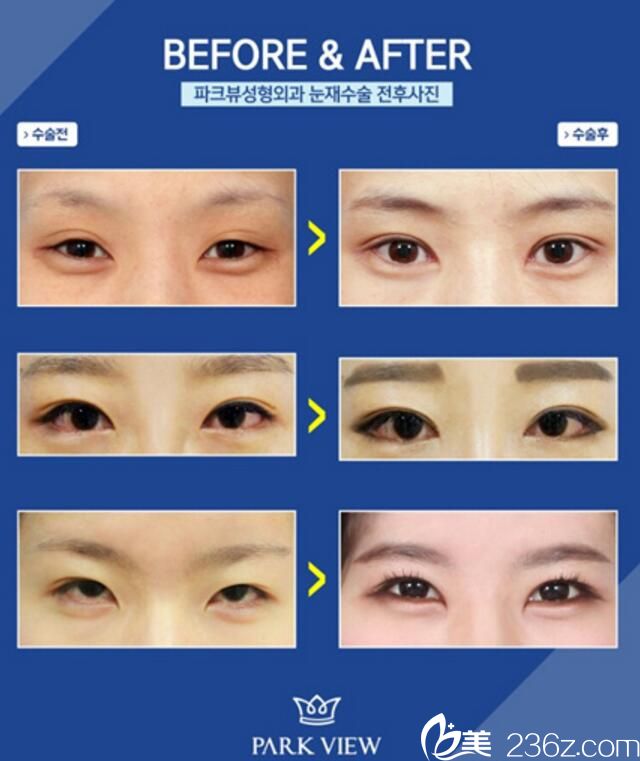韓國(guó)Parkview整形外科雙眼皮案例