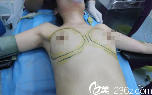 寧夏華美隆胸術中過程 寧夏華美隆胸術中過程