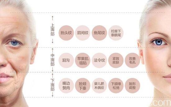 線雕提升的面部范圍