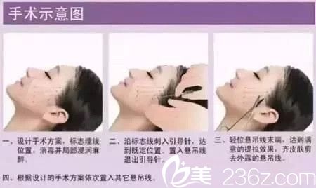 線雕手術示意圖