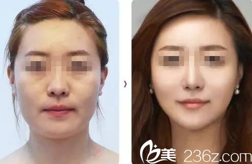 線雕前后對比圖