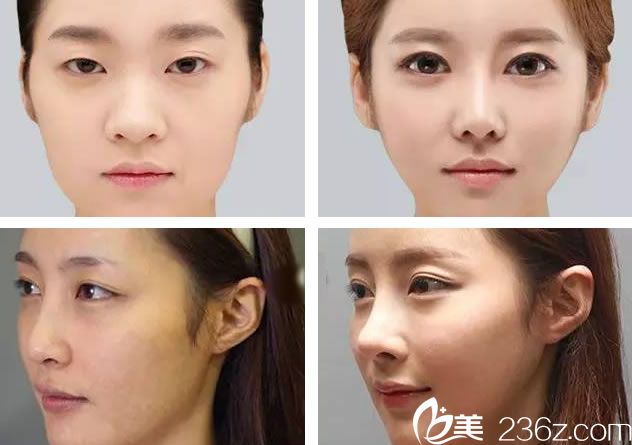 杭州譚曉燕隆鼻真人案例 杭州譚曉燕隆鼻真人案例