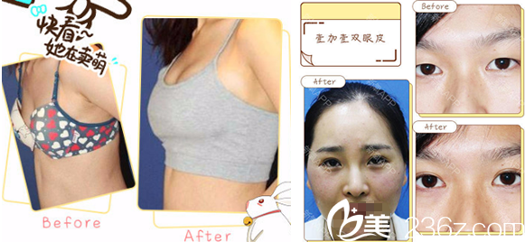 合肥壹加壹<!--<i data=20240703-sp></i>-->豐胸+雙眼皮手術(shù)案例 合肥壹加壹<!--<i data=20240703-sp></i>-->豐胸+雙眼皮手術(shù)案例