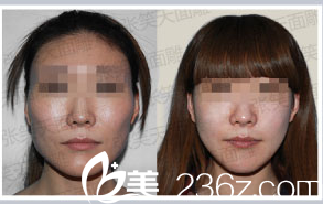 北京圣嘉新張笑天醫(yī)生改臉型案例 北京圣嘉新張笑天醫(yī)生改臉型案例