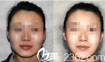 北京圣嘉新張笑天面部輪廓整形案例 北京圣嘉新張笑天面部輪廓整形案例