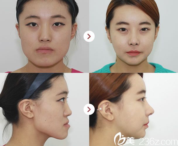 韓國姜永浩院長雙鄂手術(shù)案例