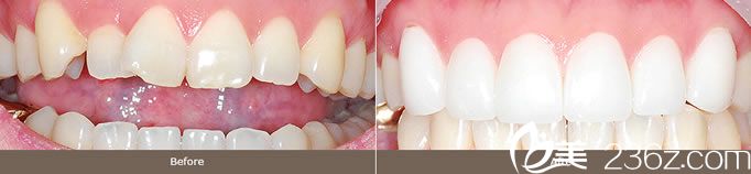 金亨奎院長(zhǎng)的全瓷冠美牙效果 金亨奎院長(zhǎng)的全瓷冠美牙效果