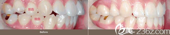 金允宣院長(zhǎng)凸嘴牙齒矯正案例 金允宣院長(zhǎng)凸嘴牙齒矯正案例