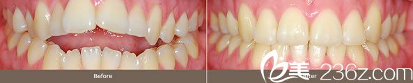 全輝院長(zhǎng)開(kāi)放式咬合牙齒矯正案例 全輝院長(zhǎng)開(kāi)放式咬合牙齒矯正案例
