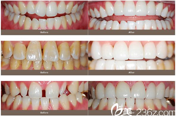 李東奎院長(zhǎng)前牙瓷粘結(jié)性仿生修復(fù) 李東奎院長(zhǎng)前牙瓷粘結(jié)性仿生修復(fù)