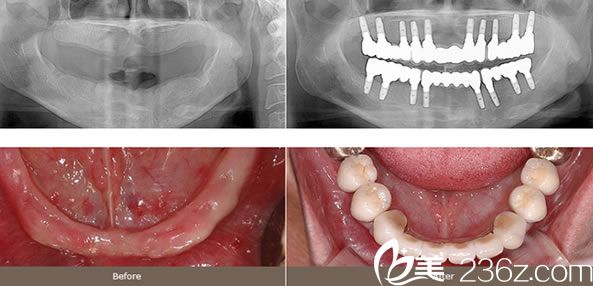 李東奎院長(zhǎng)整體植牙案例 李東奎院長(zhǎng)整體植牙案例